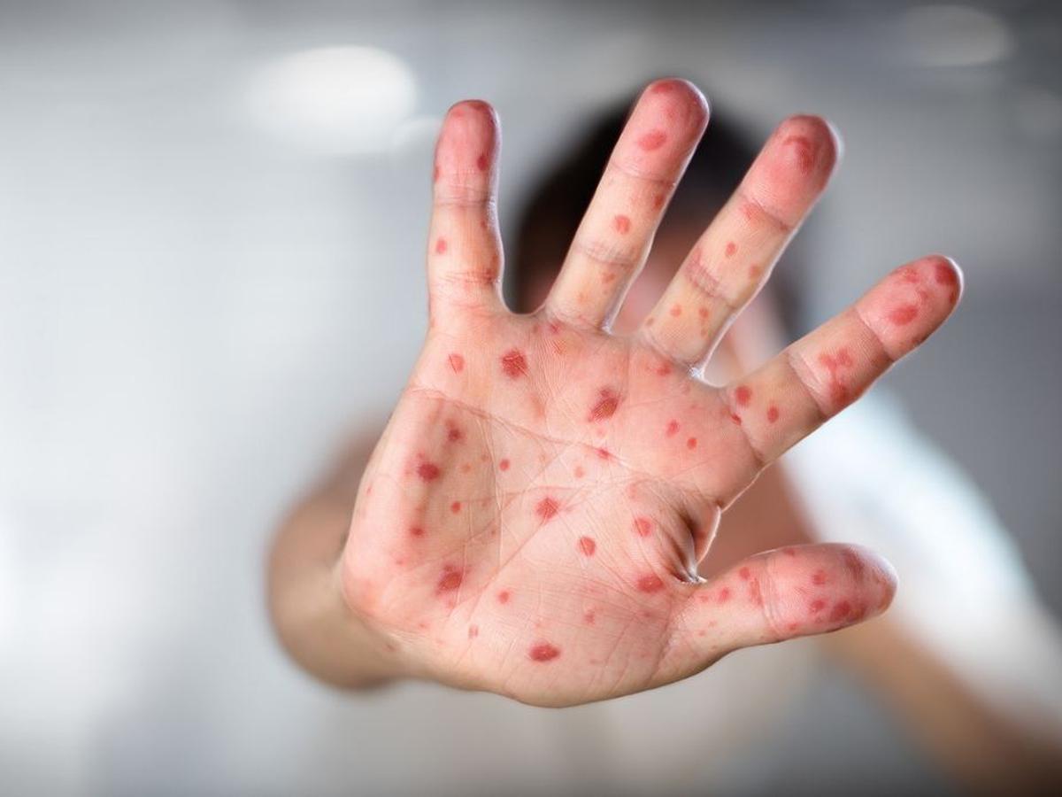 Viruela del mono "bajo control" en el país, según Salud Pública