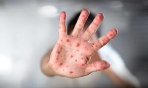 Primer caso de sarampión en 25 años se registra en Paraguay