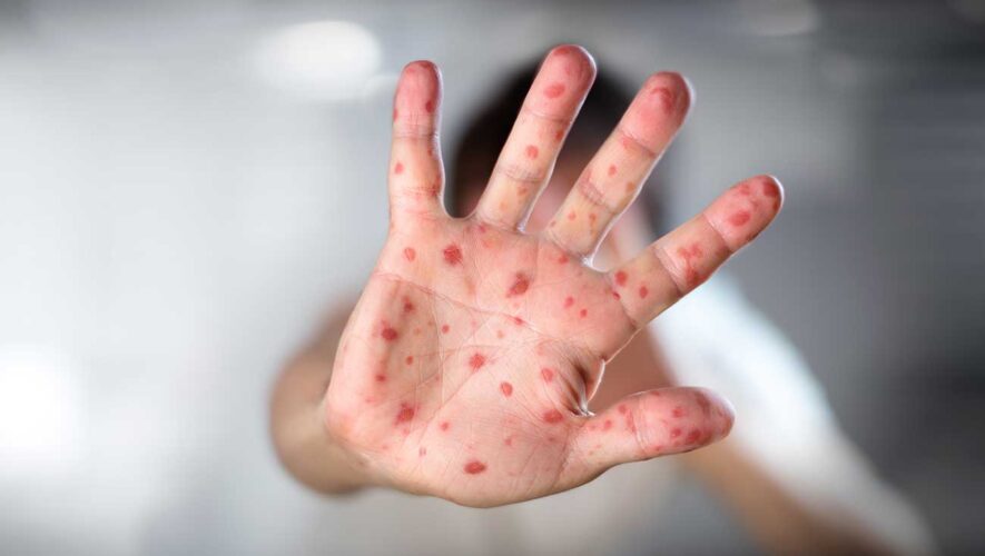 Primer caso de sarampión en 25 años se registra en Paraguay